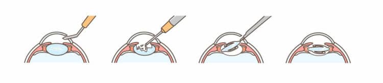 Cataract Incision Closure Cataract Surgery Port Orange | Cataracts Ormond Beach, FL